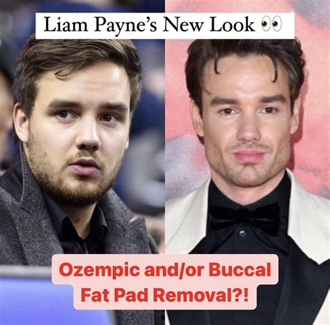 liam payne fat removal.